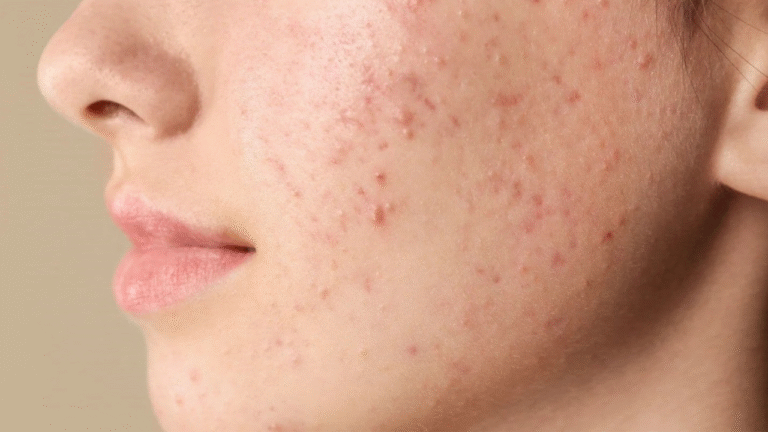 Acne Treatment