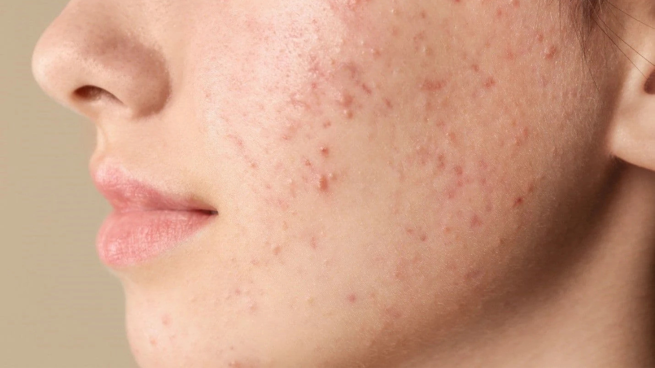 Acne Treatment